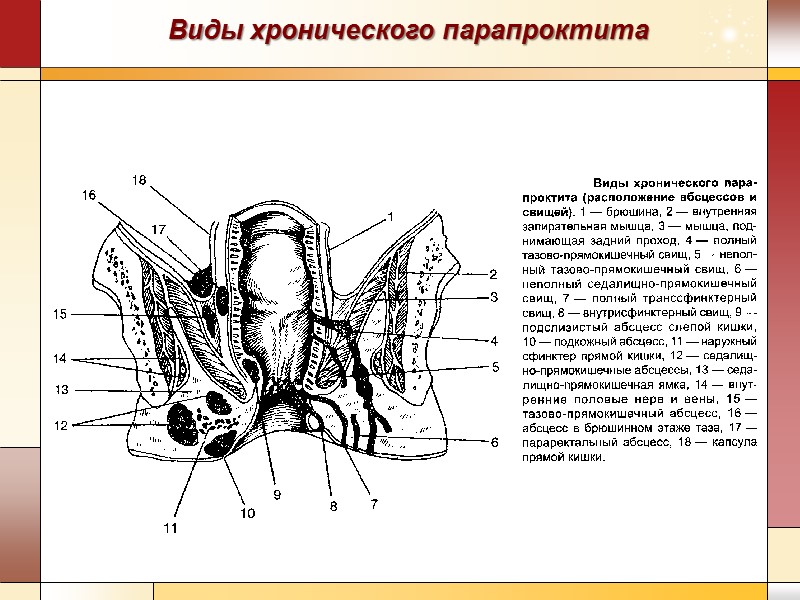 Виды хронического парапроктита